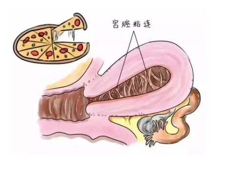 美國試管嬰兒費用及流程？